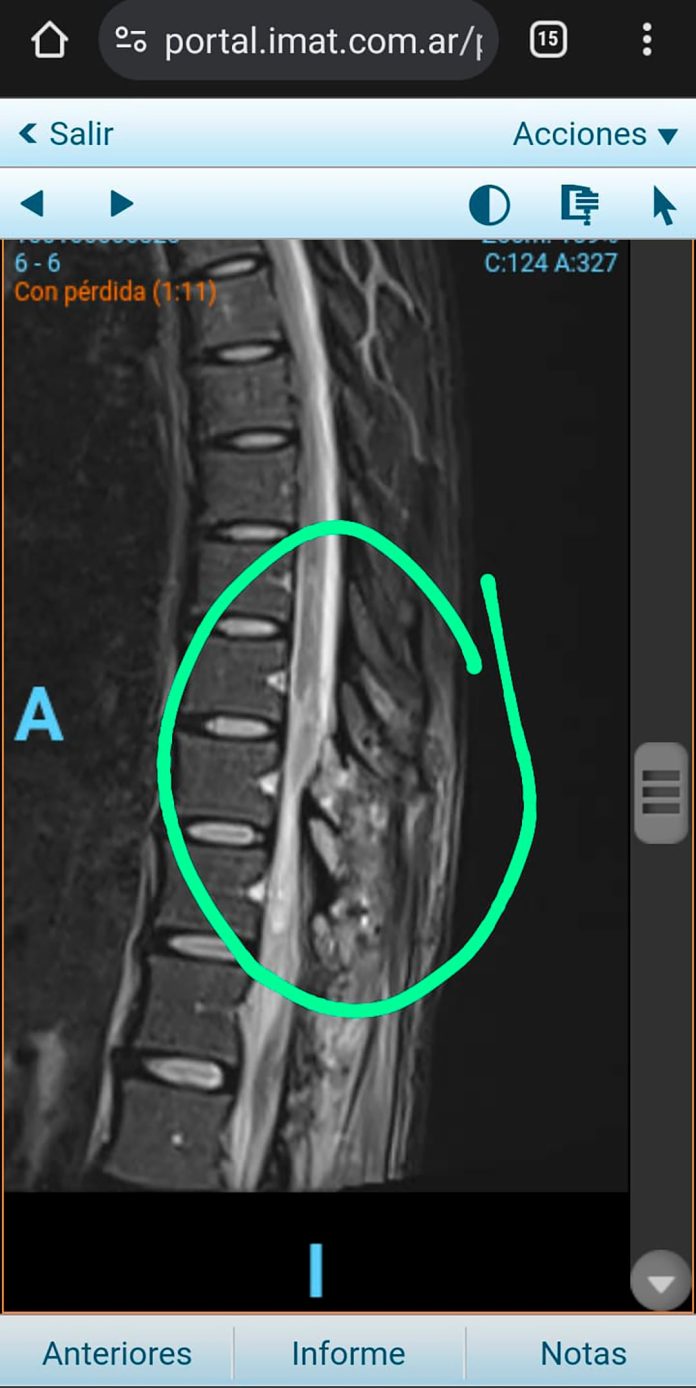 El drama de una chica que se operó para mejorar un calambre y ahora no puede caminar: denuncia mala praxis